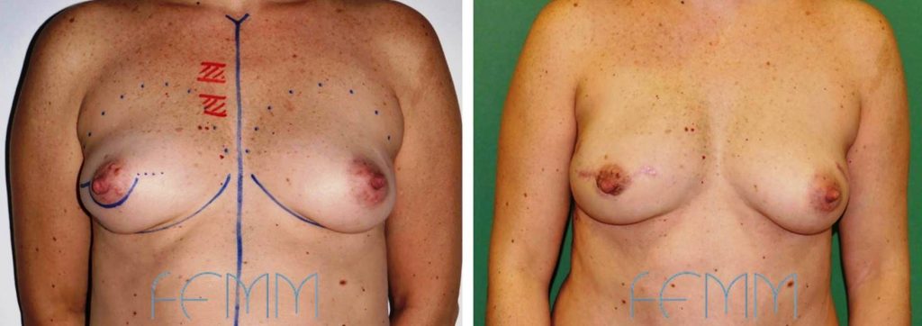 ¿Cuál es el mejor método para reconstruir la mama tras un cáncer?