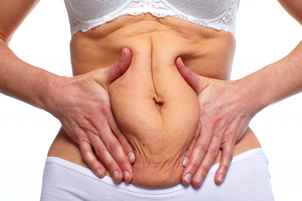 ¿Estás pensando en reducir tu abdomen? Mitos y realidades de la abdominoplastia
